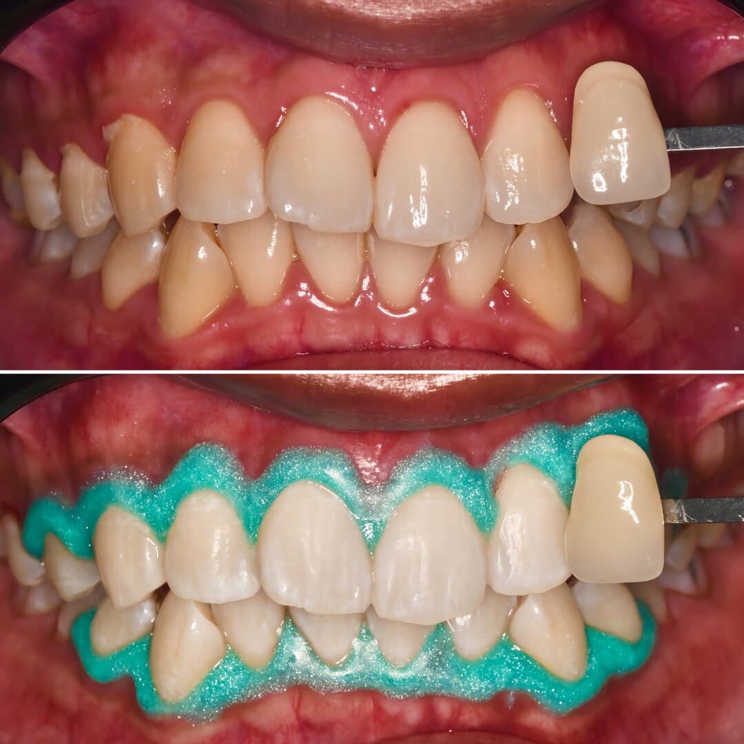 Teeth Whitening β before and after